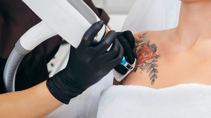 Laser Treatment For Tattoo Removal In Tuticorin | Tirunelveli - A+